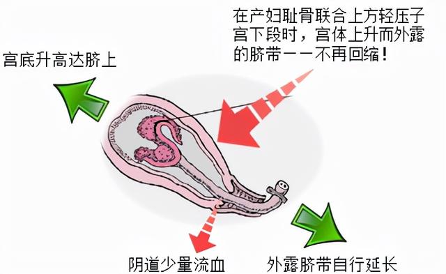 生孩子是突然发动还是有预兆，分娩发动是突然的吗（胎位为什么头先出来是正常）