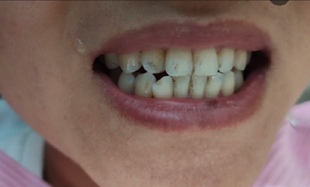 2,烟渍,茶渍通通消除!成本几毛钱的白牙妙招来袭,学会了终身受益