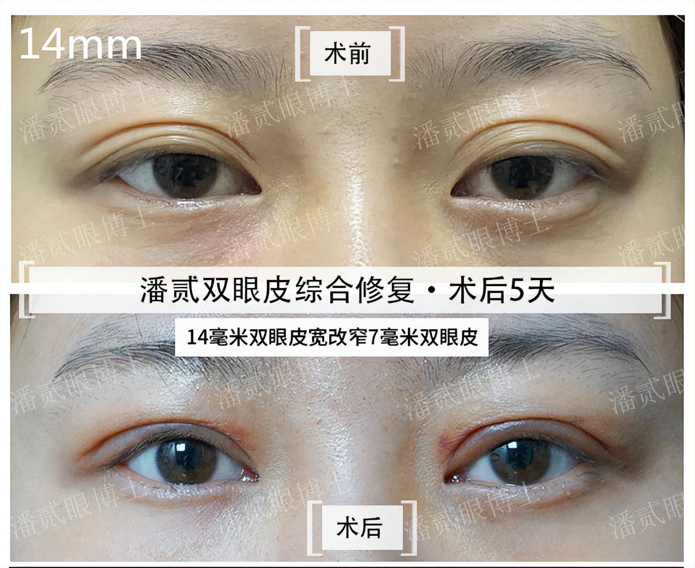 双眼皮失败案例（割超过10mm假大宽双眼皮还能修复变窄）