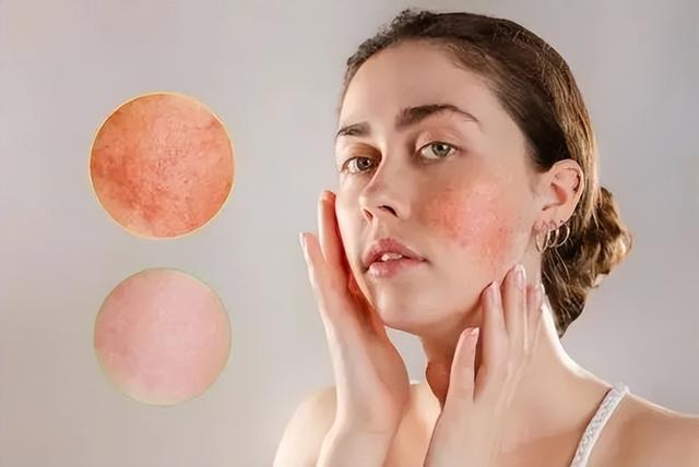 脸上过敏发红发痒，脸部过敏发痒发红怎么办（夏季脸部过敏发红发痒紧绷……教你三个方法科学应对）