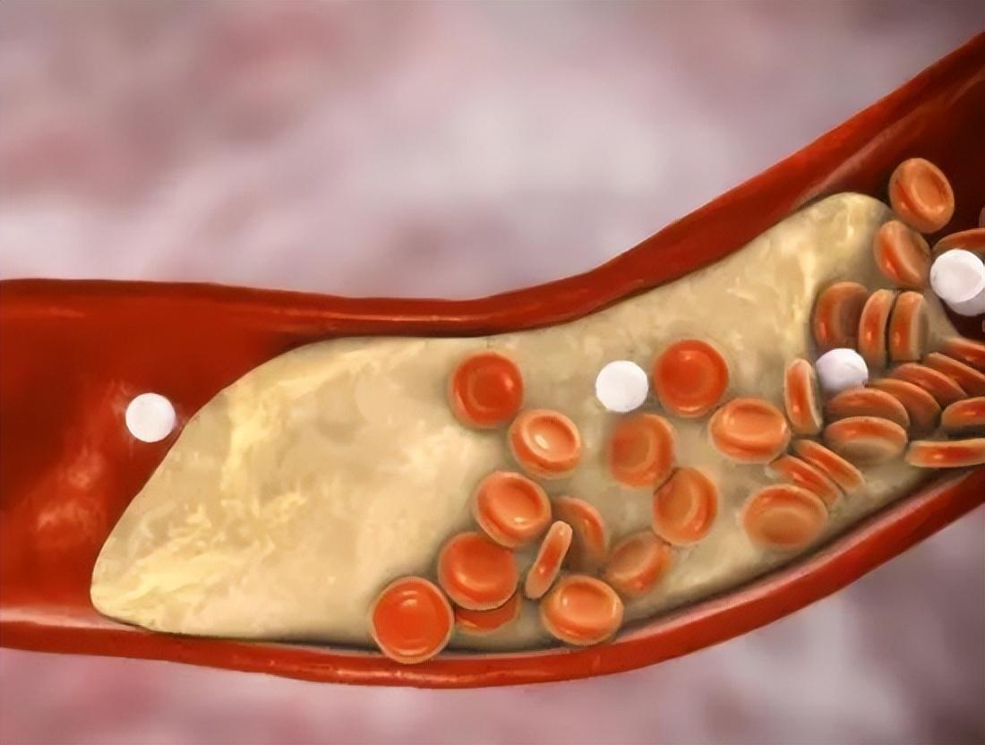 三,如何控制甘油三酯?