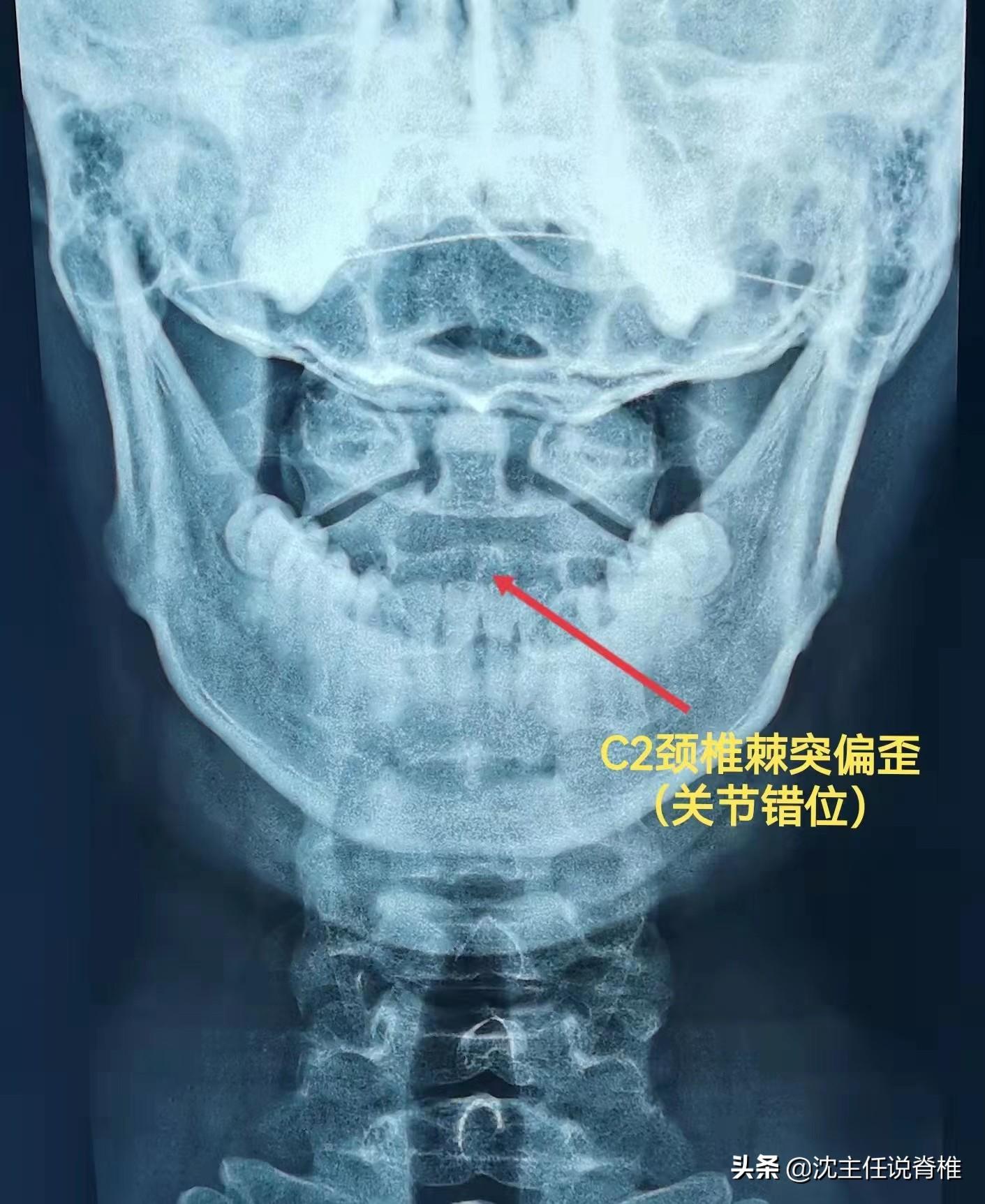 颈椎棘突图片图片