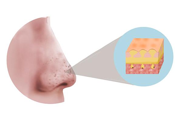 被螨虫咬的症状是什么，被螨虫叮咬的症状（被螨虫缠上的危害）