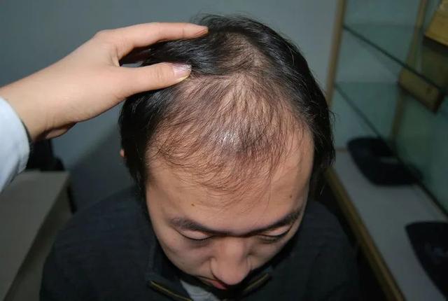 种植牙后如何护理 种植牙会有后遗症吗，种植牙后如何护理（植发要花“一套房”）