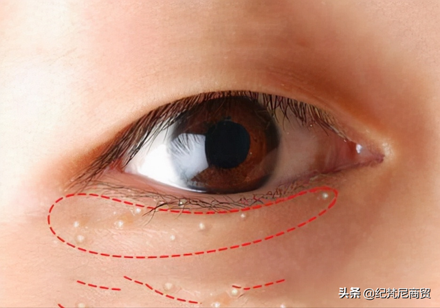 脸上为什么会长脂肪粒，脸上长脂肪粒什么原因（脂肪粒是怎样造成的）