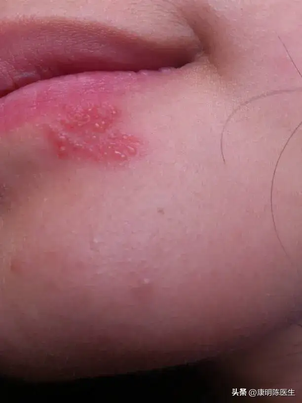 疱疹一般多久能自愈？