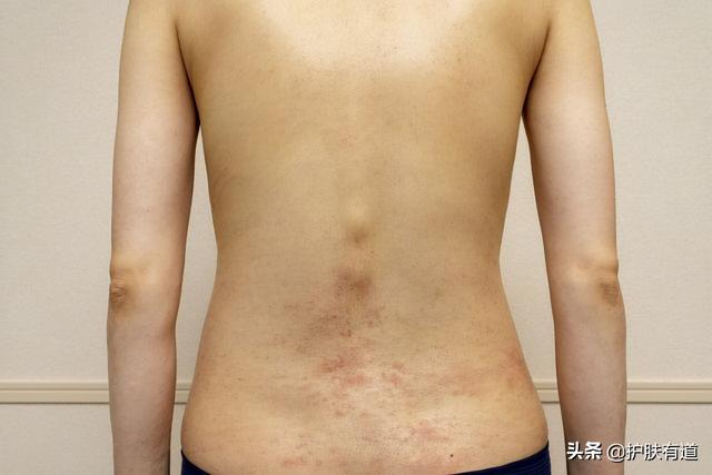 长暗疮怎么办，一直长暗疮怎么办（ 拆解8个暗疮部位）