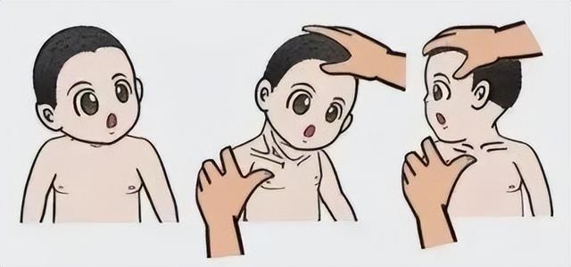 歪脖子是什么意思，涟漪是什么意思怎么读（关于小儿斜颈，你知多少）