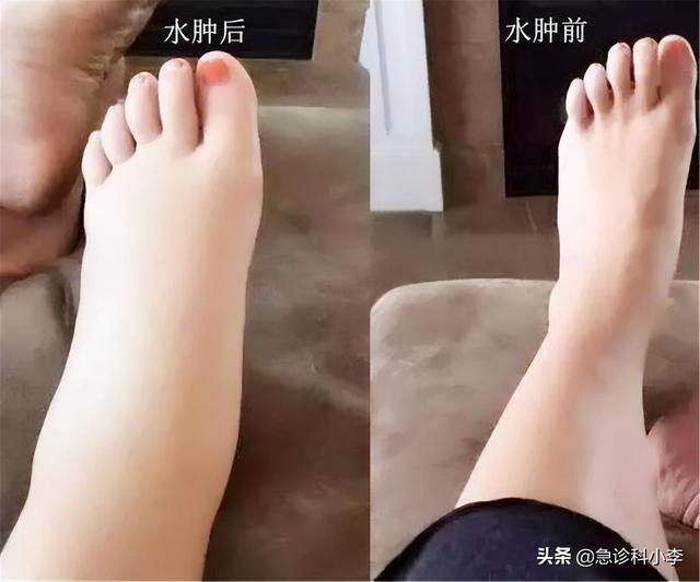 感冒可以吃西瓜吗，咳嗽可以吃西瓜吗（爱吃西瓜的人注意了）