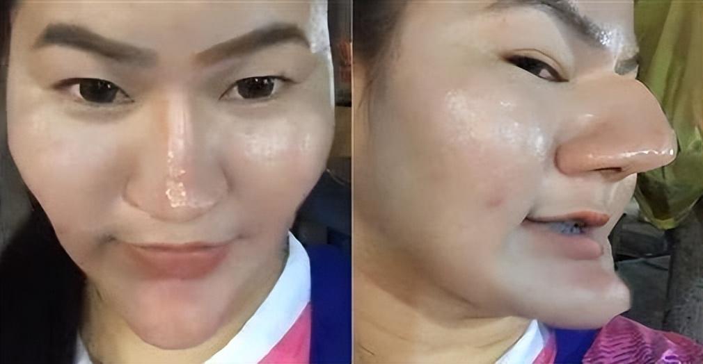 女生花上百万整容,想整成"公主"却变"女巫",假体填充太严重