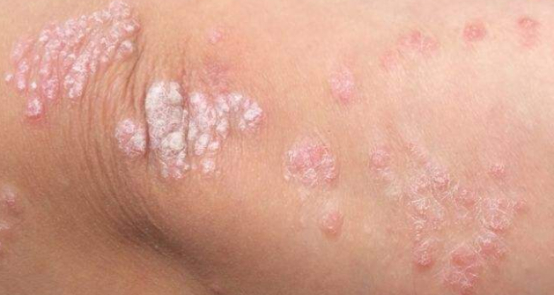 皮肤角化症怎么治，毛囊角化症怎么治疗（但可以通过治疗缓解）