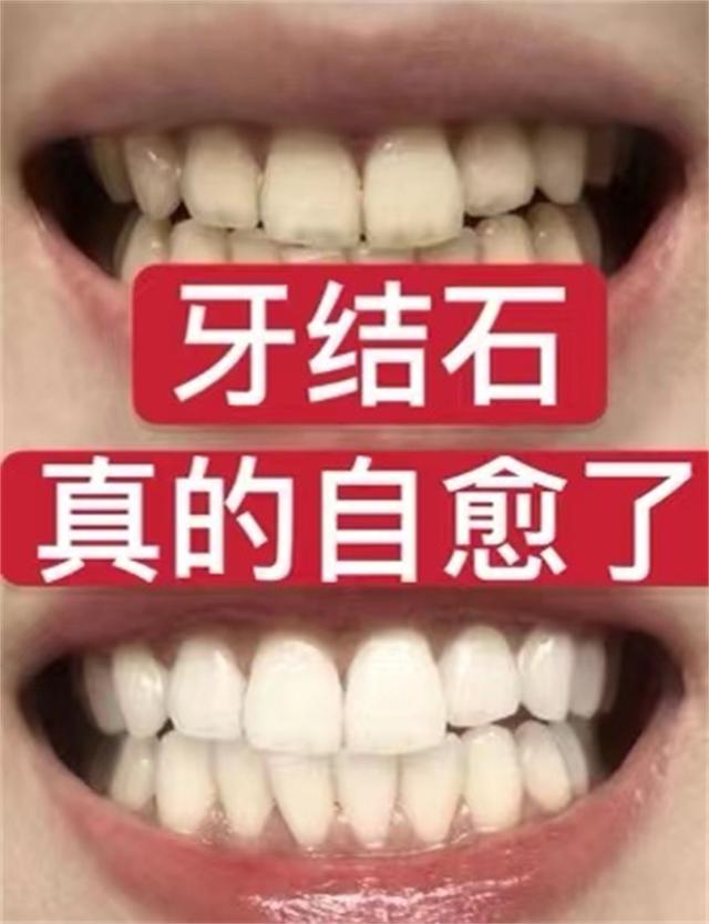 牙结石自己脱落小妙招，牙结石脱落小妙招（再臭的牙石也能自己掉）
