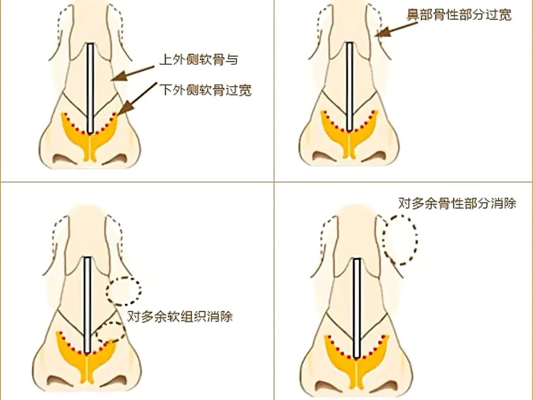 鼻翼宽大怎么变小(瘦鼻子的有效方法)插图(1)