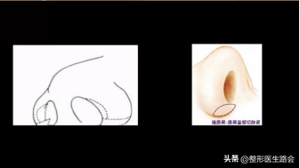 鼻翼肥大怎么办，鼻翼肥大怎么改善（如何改善鼻头圆和鼻翼宽）