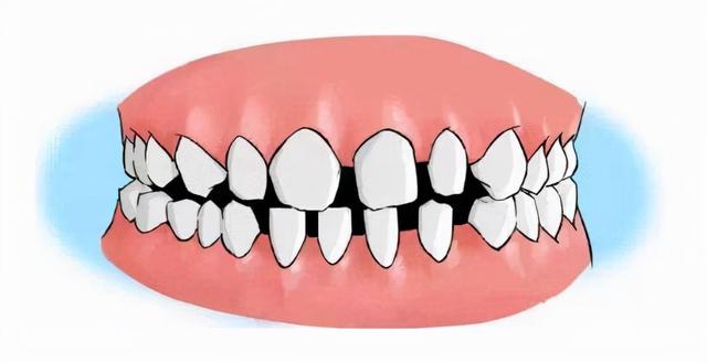 牙齿有缝怎么弄,牙齿有缝怎么办(牙缝大会"漏财"还毁颜值)