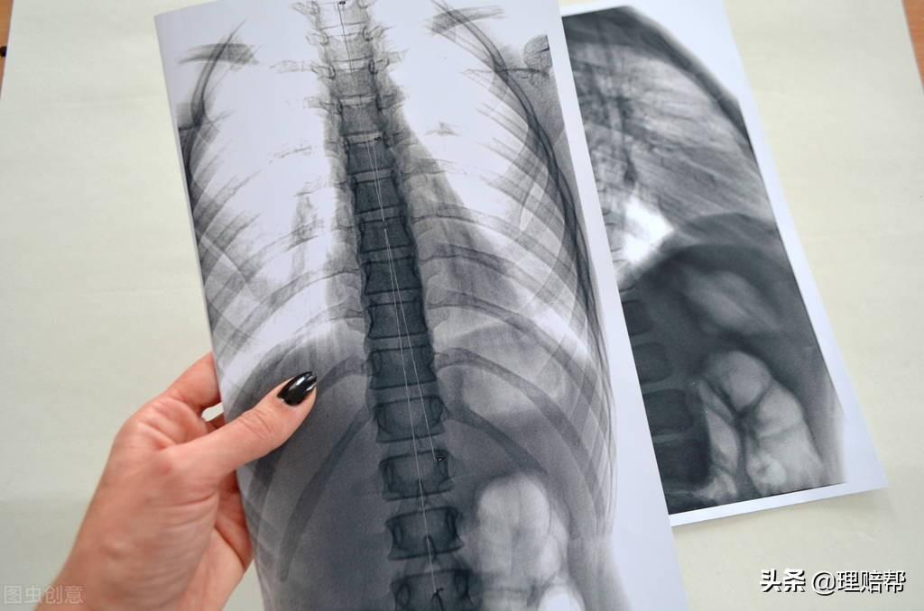 孩子住院学校的保险能不能报（学生患先天性脊柱侧弯）