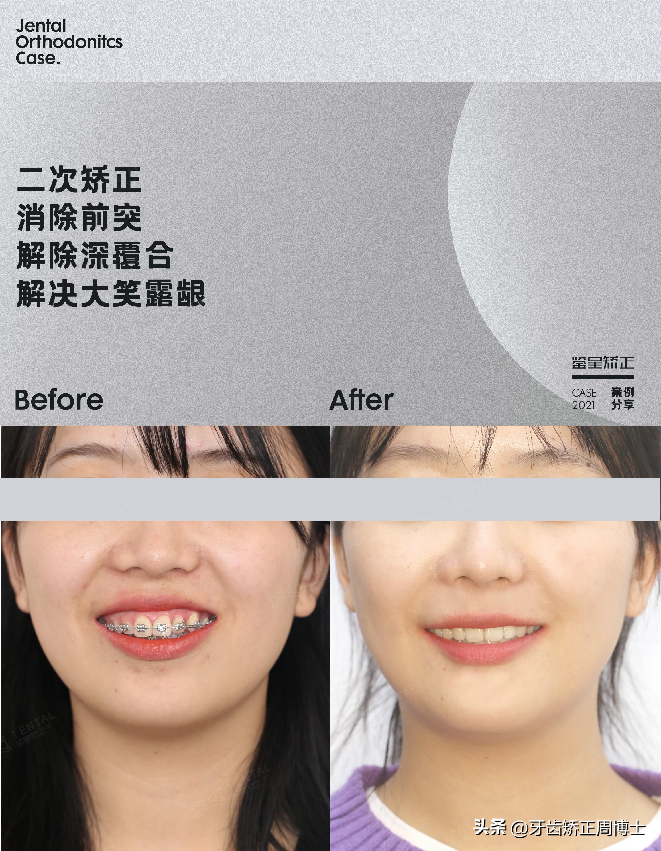 牙齿矫正案例（二次矫正案例分享）