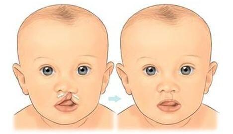 兔唇可以治好吗，兔唇能治好吗（家长的在意点尤其重要）