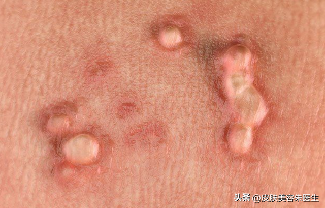 疣的分类与治疗，还有这几种疣也很常见