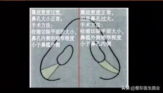 鼻翼肥大怎么办，鼻翼肥大怎么改善（如何改善鼻头圆和鼻翼宽）