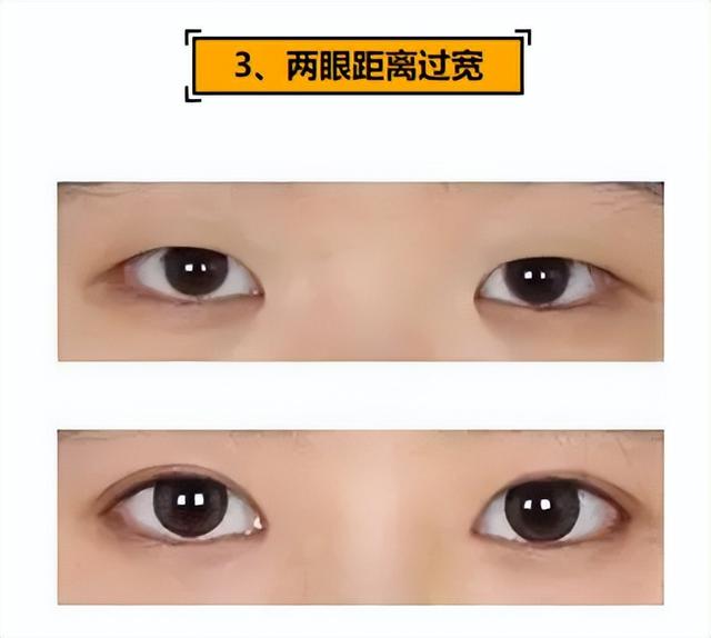 割双眼皮最佳季节，双眼皮6 7 8毫米效果图（开眼角手术答疑解惑）