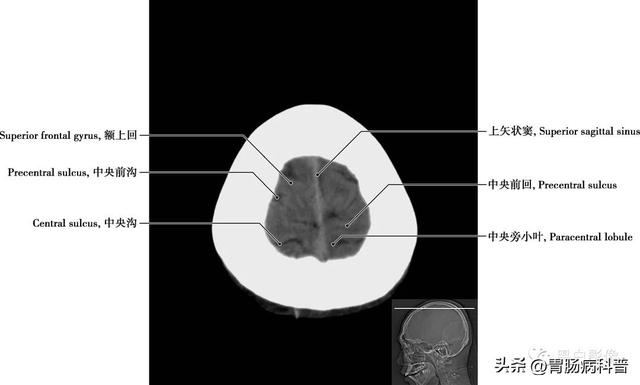 智力扣全套解法图解，智力扣九连环解法（详细标注版——颅脑CT正常解剖图谱）