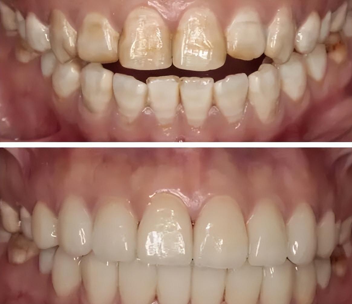 牙齿患有这种黄斑,早发现不用治疗也能好