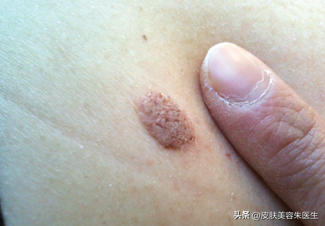 疣的分类与治疗，还有这几种疣也很常见