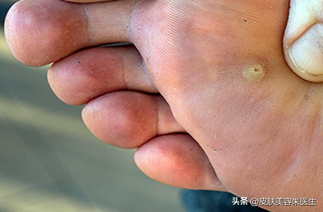 疣的分类与治疗，还有这几种疣也很常见