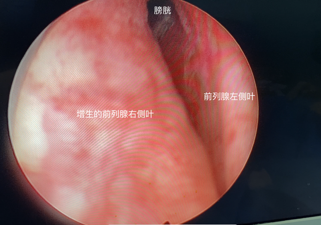 盐酸坦索罗辛缓释片，前列腺炎四大常用药（前列腺增生长期口服坦索罗辛会导致肾功能损伤）