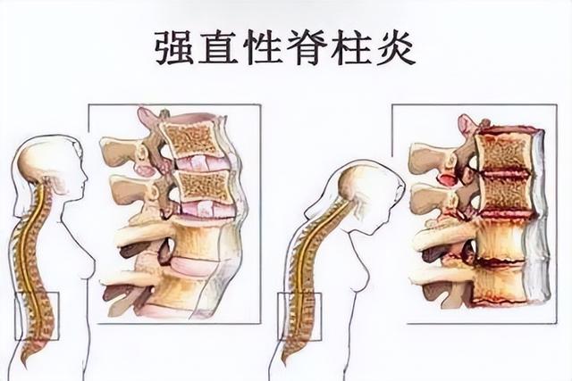 什么人不能吃牛肉，生病的人不能吃牛肉吗（患有强直性脊柱炎的人）