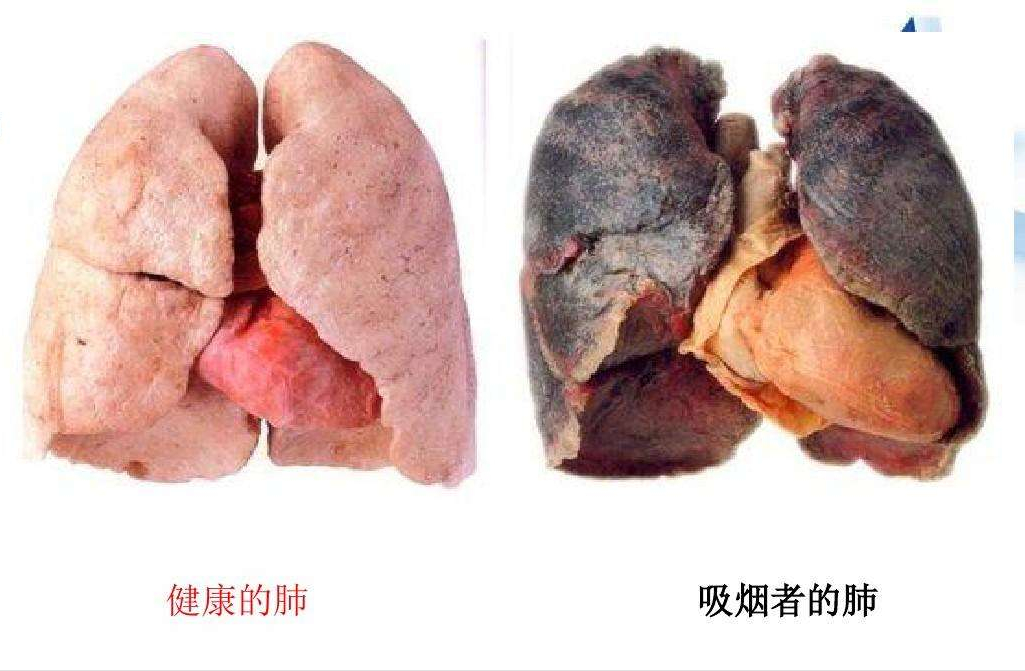 戒烟后的肺图片