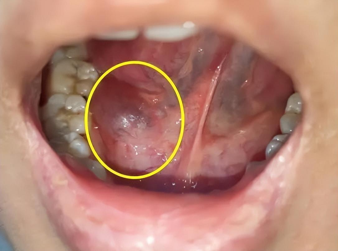 「科普」您知道什么是舌下腺囊肿吗?