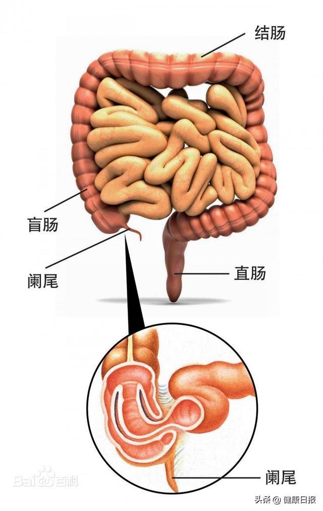 阑尾炎怎么办快速止疼方法，阑尾炎怎么办快速止疼方法吃什么药（阑尾一定要割掉吗）