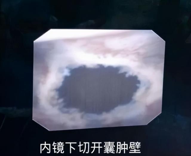 肾囊肿最佳治疗方法，肾囊肿最佳治疗方法有什么（肾囊肿治疗新方法）