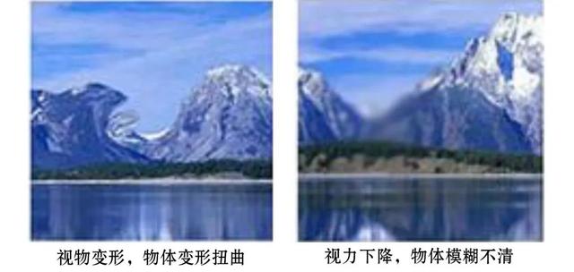 视网膜上的黄斑是什么，视网膜黄斑为什么是黄色（黄斑区多长了一层“膜”严重损害视力）