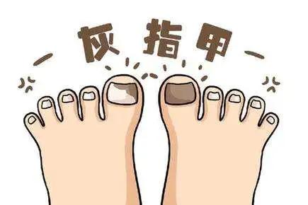 灰指甲刚开始的图片,灰指甲图片(“灰指甲”长啥样) 灰指甲刚开始的图片,灰指甲图片(“灰指甲”长啥样)