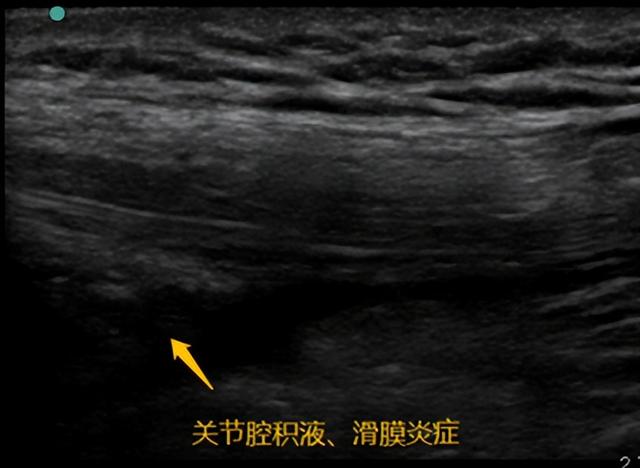 波棱盖是什么意思，东北话里的波棱盖儿是指什么（康复科医生说：你还太“年轻”）