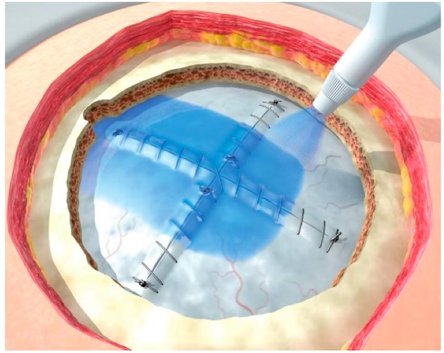 生物医用材料主要应用在哪些方面，常见的生物医用材料有哪些（医疗器械领域好帮手）