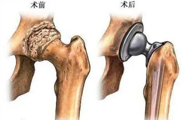 股骨头是哪个位置，股骨头在人体的哪个位置及作用（您得小心股骨头坏死）