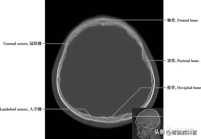 智力扣全套解法图解，智力扣九连环解法（详细标注版——颅脑CT正常解剖图谱）