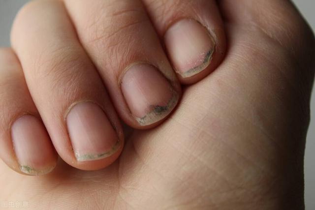 指甲盖里有一小块白色，手指甲有白色的小块怎么回事（或许与这几个原因有关）