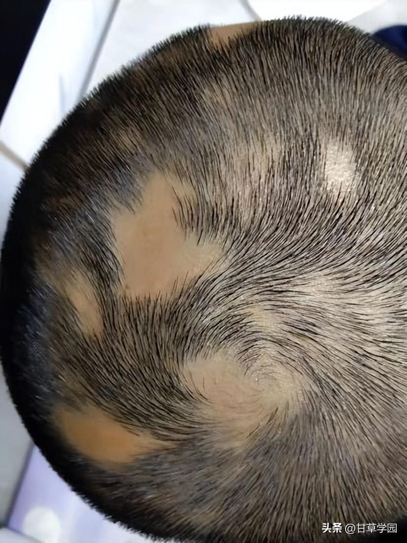 婴儿额头突然白了一块,小儿白秃疮合并斑秃一则 - 玉三网