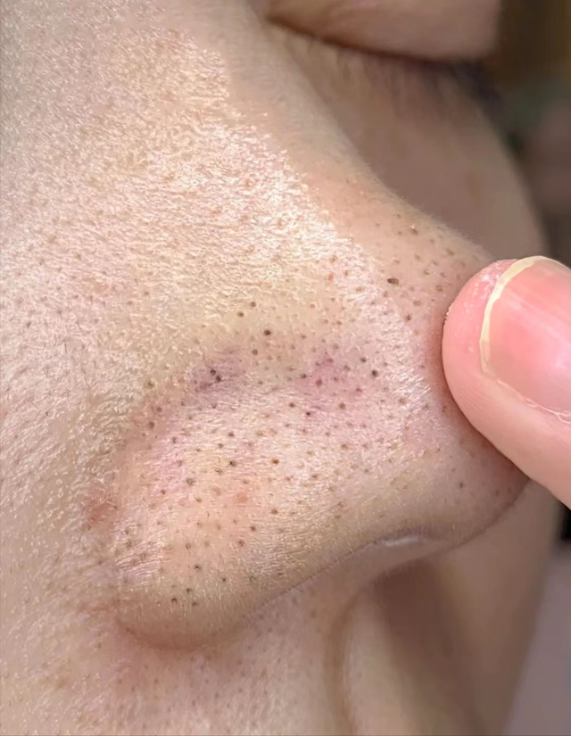 学生如何自己去黑头，想要短期内改善黑头情况