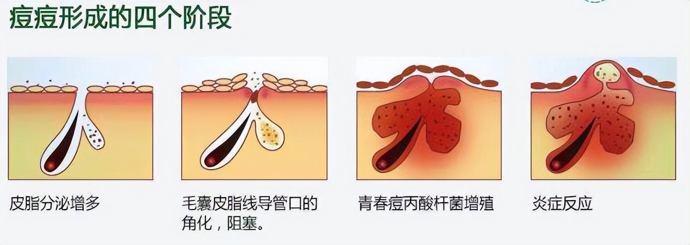 如何去痘印最有效果，淡化痘印的小妙招