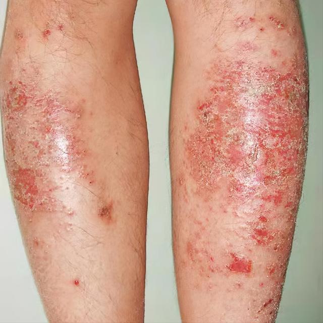 干燥性湿疹的症状图片图片