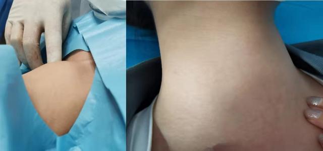 甲状腺4a必须手术吗，甲状腺4a类需要做手术吗（查出甲状腺结节4a类怎么治疗）