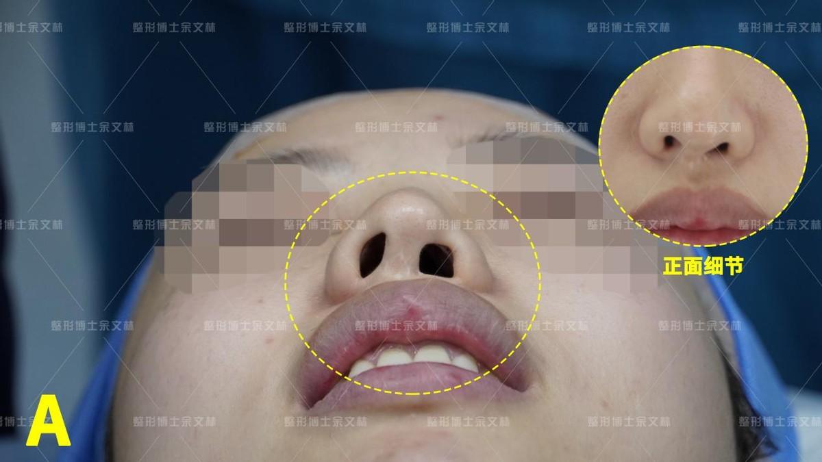 鼻翼不对称面相,「鼻整形修复」小姐姐左边鼻孔形似方形-相术-荣耀