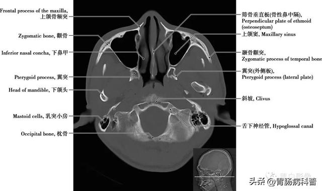 智力扣全套解法图解，智力扣九连环解法（详细标注版——颅脑CT正常解剖图谱）