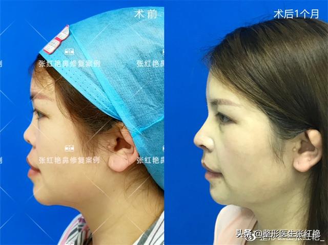 鼻孔大怎么办，鼻子太大怎么自然缩小（成功改造后气质“大变样”）